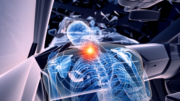 3D rendered illustration of two colliding cars - illustrating the effect of an impact of a car accident on a person's back, neck, and spine. (250310572)